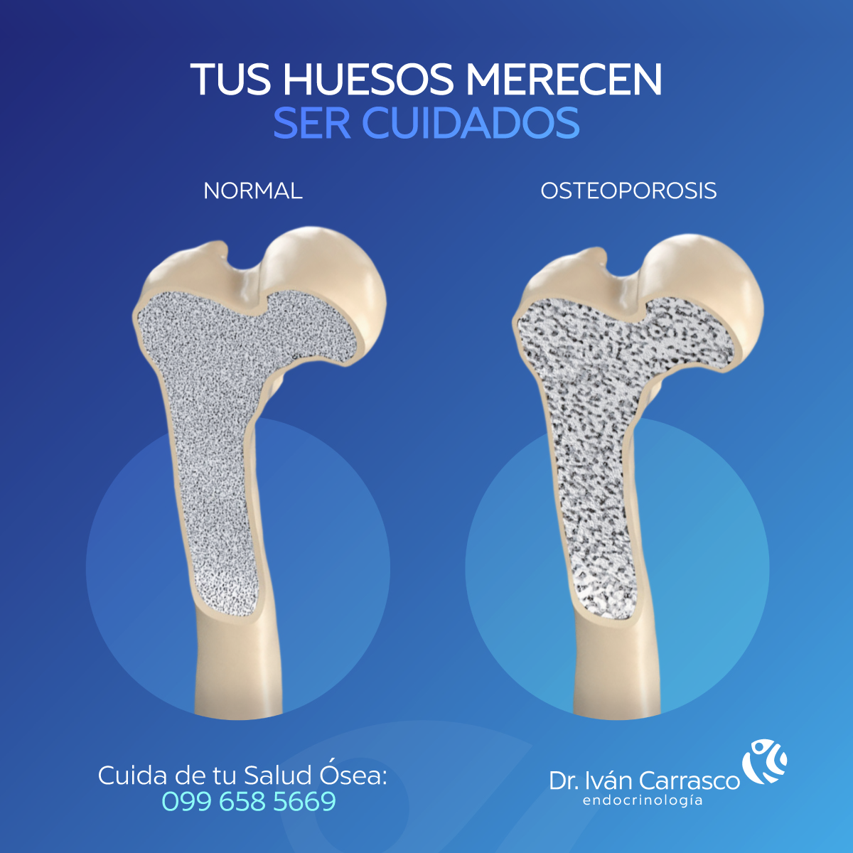 OSTEOPOROSIS post thumbnail
